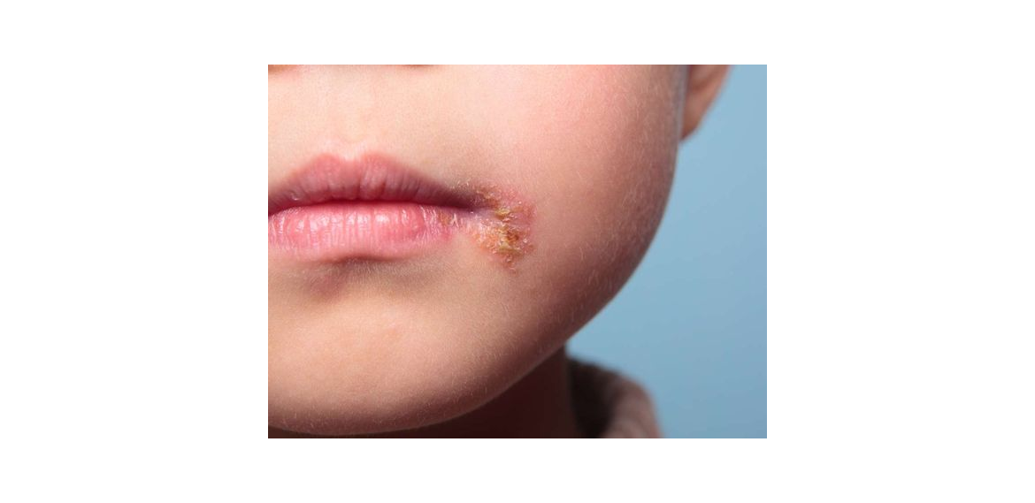 تبخال کودکان